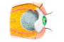 Scleral Shell | Anophthalmos |